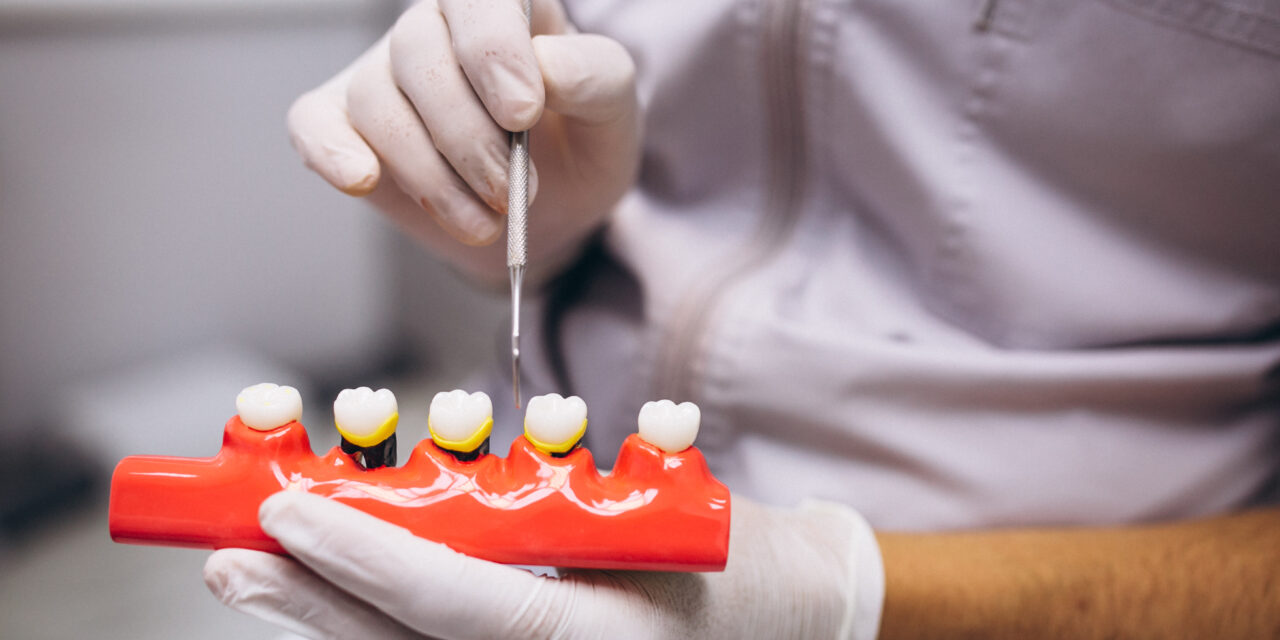 How Dental Implants Mississauga Can Improve Your Oral Function