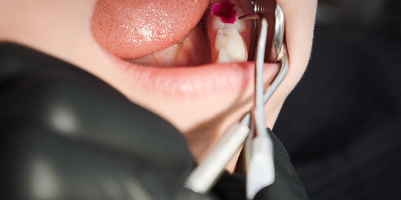 How Much Does a Root Canal Cost in Mississauga in 2026?