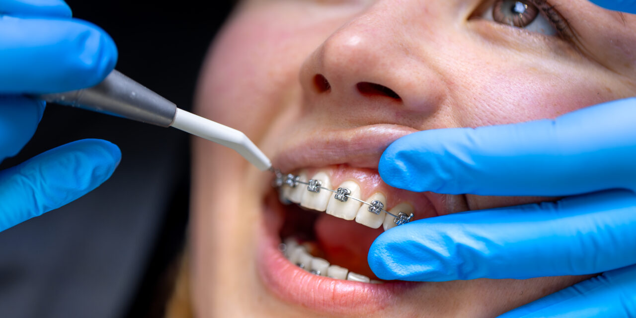 Adult Orthodontics Is Trending – Here’s What You Should Know