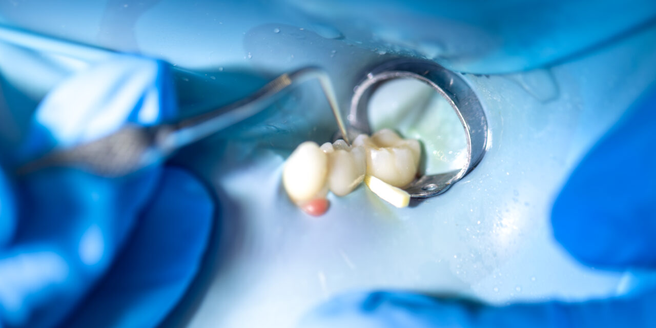Root Canal Treatment Demystified: What Really Happens During the Procedure