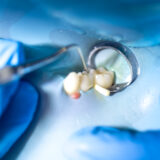 Root Canal