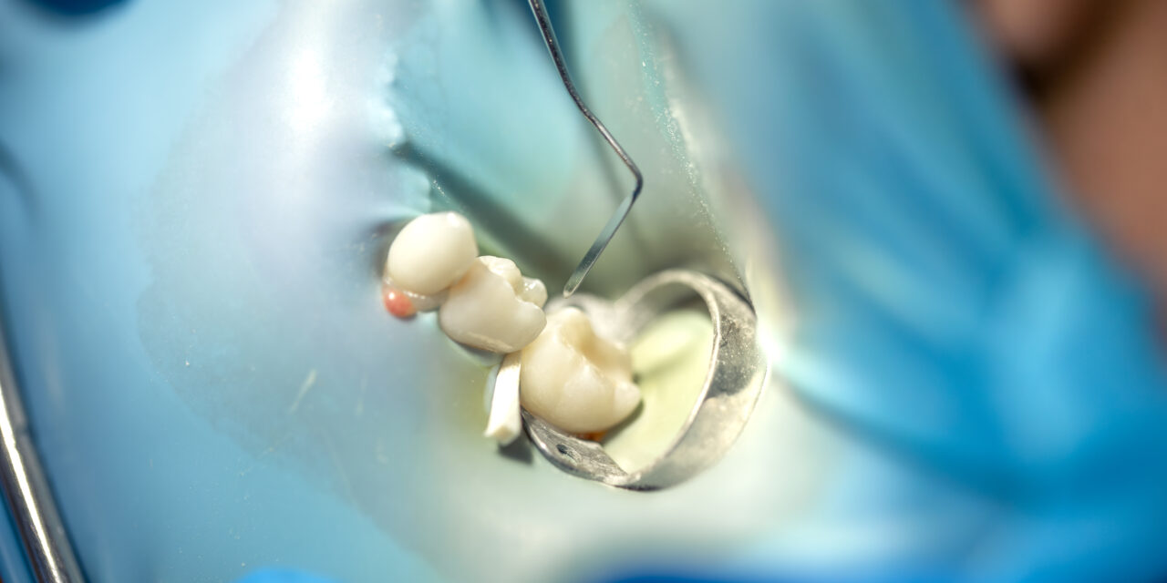 Root Canal Treatment Breakthroughs Helping Patients Keep Their Natural Smiles