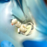 root canal treatment
